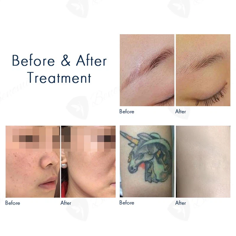 ND-YAGDiode-laser-D1-13